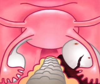 Endometriosezyste