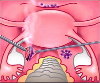 Koagulation von Endometrioseherden